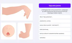 Tężyczka jawna: ilustracje przedstawiające rękę w pozycji "położnika", twarz z wykrzywionymi ustami i stopę.