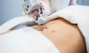 Zabieg liposukcji kawitacyjnej na brzuchu. Sprawdź, jaka jest liposukcja kawitacyjna cena i zacznij modelować sylwetkę.