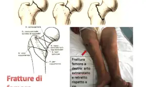 Illustrazione tipi frattura femore e gamba con frattura. La prognosi e quanto si vive dopo frattura femore dipendono da molti fattori.