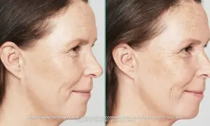 Porównanie skóry przed i po zabiegu skinbooster. Widać wygładzenie drobnych zmarszczek i poprawę nawilżenia.