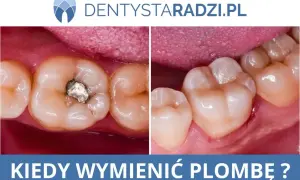 Przed i po: stara plomba metalowa zastąpiona nową, estetyczną. Stomatologia zachowawcza w praktyce.