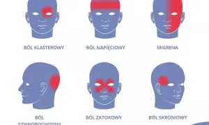 Ilustracja pokazuje różne rodzaje bólu głowy, w tym te spowodowane stresem. Czerwone obszary na głowach symbolizują lokalizację bólu.