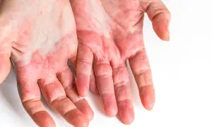 Mani con arrossamento e secchezza, sintomi di dermatite da contatto. Si cercano rimedi efficaci per alleviare il prurito e l'irritazione.