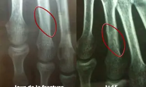 Radiographie du pied montrant une fracture du 4ème métatarsien droit, jour de la fracture et J+45. La guérison prend du temps.