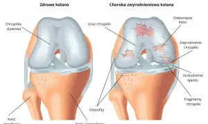 Porównanie zdrowego kolana z kolanem ze zwyrodnieniem, pokazujące uszkodzenia chrząstki i kości.