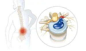 Illustration d'une discopathie lombaire causant une douleur la nuit, avec un disque intervertébral hernié comprimant un nerf.