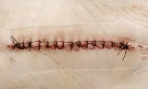 Gros plan d'une plaie suturée, où un fil de suture reste dans la plaie, témoignant du processus de guérison.