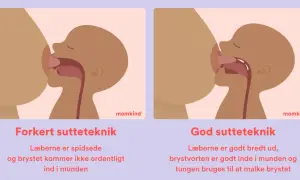 Illustrationer visar fel och rätt amningsteknik. Fel teknik: spetsade läppar, kort tungband kan hindra. Rätt teknik: breda läppar, bröstvårtan djupt inne, tungan mjölkar bröstet.