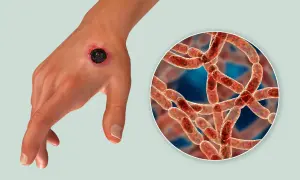 Dłoń z czarną martwicą, objawem skórnej postaci wąglika, obok powiększony obraz bakterii Bacillus anthracis.