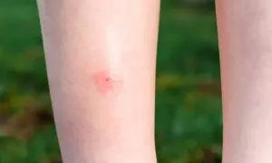 Czerwona, swędząca plamka na skórze nogi po ugryzieniu meszki.