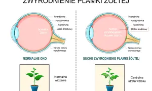 Porównanie zdrowego oka z suchym zwyrodnieniem plamki żółtej, pokazujące utratę ostrości widzenia.
