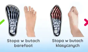 Haluksy: Geny czy buty? Odkryj prawdziwe przyczyny deformacji