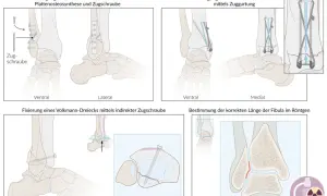 Fixierung eines Volkmann-Dreiecks mit indirekter Zugschraube am Sprunggelenk. Illustration zeigt die laterale und transversale Ansicht.