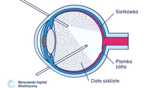 Schemat oka z zaznaczonymi elementami: siatkówka, plamka żółta, ciało szkliste. Wskazuje na nieudaną witrektomię, pokazując narzędzia wewnątrz oka.