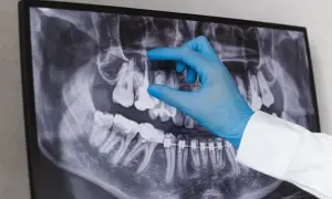Dentysta w niebieskiej rękawiczce wskazuje na zdjęcie RTG zębów, analizując sytuację przed powtórnym leczeniem kanałowym.