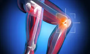 Anatomia kolana z zaznaczonym bólem, sugerującym nieleczone zerwane więzadło krzyżowe. Czerwone linie wskazują na uszkodzone tkanki.