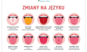 Skuteczne sposoby na pryszcz na języku – jak się pozbyć bólu i dyskomfortu