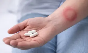 Dłoń z kilkoma białymi kapsułkami, obok zaczerwieniona wysypka na przedramieniu, być może reakcja na biotrakson.