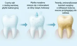 Przemiana zęba: od czystego do zżółkłego kamienia nazębnego. Proces powstawania kamienia na zębach.