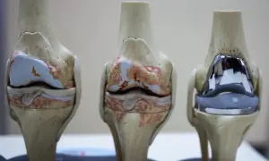 Modele anatomiczne stawów kolanowych: dwa zdrowe, jeden z endoprotezą.