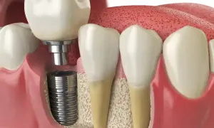 Widok przekroju dziąsła po wszczepieniu implantu zębowego. Implant jest widoczny w kości, a na nim osadzona jest korona.
