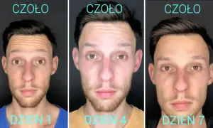 Trzy zdjęcia mężczyzny pokazujące czoło w kolejnych dniach po zabiegu. Widać, że botox jest bezpieczny i skutecznie wygładza zmarszczki.