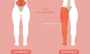 Illustration comparant le lumbago, une douleur lombaire, et la sciatique, une douleur irradiant le long du nerf sciatique.