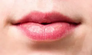 Labios rosados con piel seca y descamada, evidencia de labios quemados por el sol tras un día soleado.