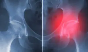 Jakie endoprotezy stawu biodrowego refunduje NFZ i co musisz wiedzieć