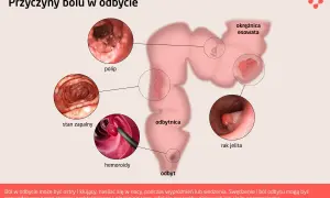 Ilustracja przedstawia przyczyny bólu w odbycie: polip, stan zapalny, hemoroidy, okrężnicę esowatą i raka jelita. Podkreśla, że podrażniony odbyt może być objawem różnych schorzeń.