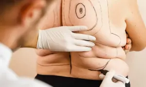 Liposukcja: Ile kg naprawdę schudniesz? Rozwiewam mity!