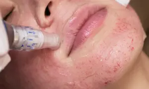 Zabieg dermapen na policzku, widoczne drobne zaczerwienienia i nakłucia. Efekty po zabiegu są obiecujące dla skóry.