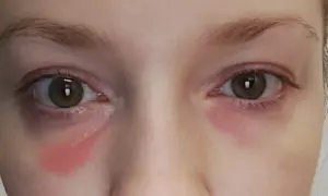 Czerwone plamy pod oczami, jakby po płaczu, ale to tylko kosmetyk.