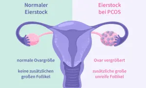 Porównanie jajnika: normalny vs. przy PCOS. Zwiększony jajnik z licznymi niedojrzałymi pęcherzykami to jeden z objawów PCOS.