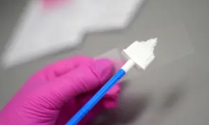 Różowa rękawiczka trzyma szczoteczkę do pobierania wymazu. Przygotowanie do cytologii cienkowarstwowej.