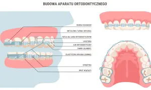 Aparat ortodontyczny: Kiedy zacząć i jakie warunki musisz spełnić?