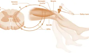 Schema del riflesso patellare. Un martelletto colpisce il ginocchio, causando un'estensione rapida dovuta all'ipertonia muscolare.