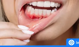 Ropień zęba a ekstrakcja: Kiedy usunąć, kiedy leczyć?