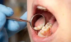 Dentysta bada budowę zębów za pomocą lusterka. Widoczne są zdrowe zęby i dziąsła.