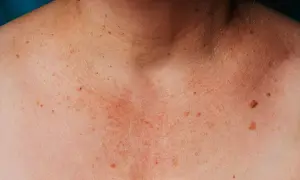 Skóra na dekolcie i szyi z licznymi piegami i plamami wątrobowymi.