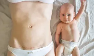 Po cesarskim cięciu, które może być związane z wadą wzroku a porodem, mama i dziecko leżą obok siebie.