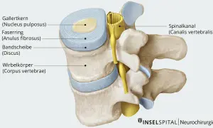 Querschnitt einer Bandscheibe mit Gallertkern und Faserring, die auf einen Spinalkanal drückt. Dies zeigt eine breitbasige Bandscheibenprotrusion.