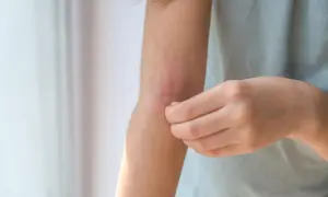 Ręka z zaczerwienioną, swędzącą skórą na zgięciu łokcia.
