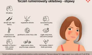 Grafika przedstawia objawy tocznia rumieniowatego układowego (SLE): ból głowy, obrzęki, wypadanie włosów, owrzodzenia jamy ustnej, gorączkę, utratę wagi, zmęczenie, wysypkę motylkową, problemy psychiczne i bóle stawów.