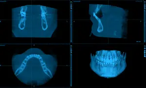 Trzy widoki tomografii komputerowej szczęki i żuchwy. Widok osiowy pokazuje łuk zębowy. Ile kanałów ma 7 zębów? To pytanie dla dentysty.