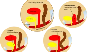 Illustrationer visar hur livmoderframfall, cystocele och rektosele ser ut.
