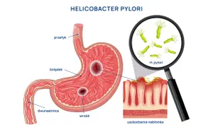 Helicobacter pylori uszkadza żołądek, powodując wrzody. Choć obraz skupia się na fizycznych objawach, warto pamiętać o potencjalnych helicobacter pylori objawy psychiczne, jak stres czy niepokój.