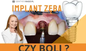 Implant zęba czy boli? Uśmiechnięta dentystka i zbliżenie na implant w trakcie zabiegu.