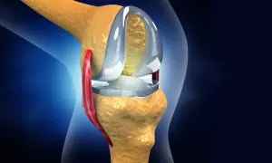 Knieprothese im Detail. Nach einer Meniskus-OP wie lange krank? Rehabilitation ist entscheidend.