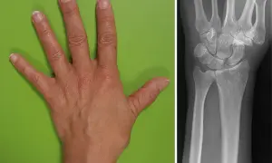 Hand und Röntgenbild des Handgelenks. Der **flexor carpi radialis** ist ein wichtiger Muskel für die Handbewegung.